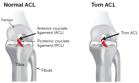 Healthy and Unhealthy ACL